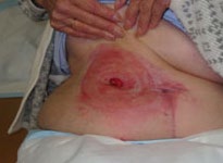 difficult to access stoma