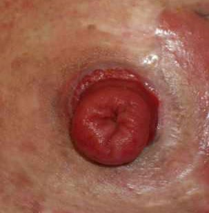 a stoma